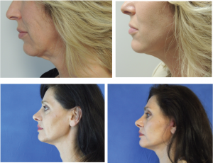 HOW TO CHOOSE THE BEST FACELIFT PLASTIC SURGEON