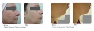 Image of Before and After Neck and Face Procedure with Alma VShape Laser
