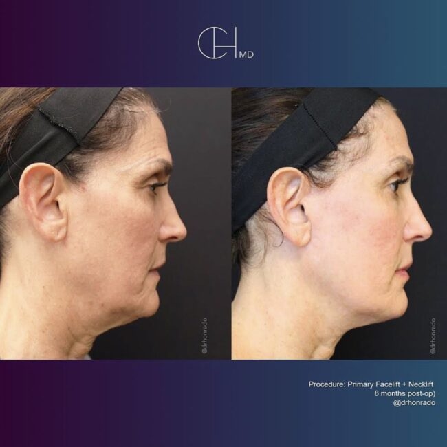 Primary Facelift (Rhytidectomy) Before and After by DrHonrado