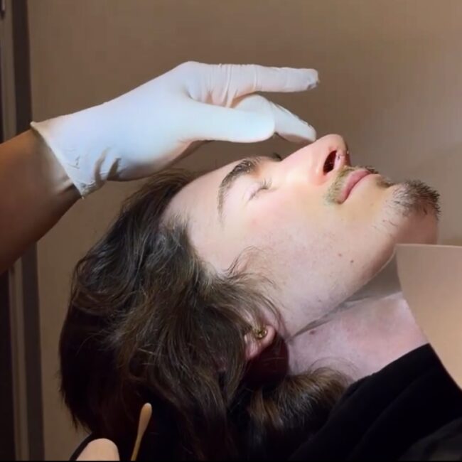 Patient laying down, side view, Post Septoplasty and Rhinoplasty by Dr. Honrado