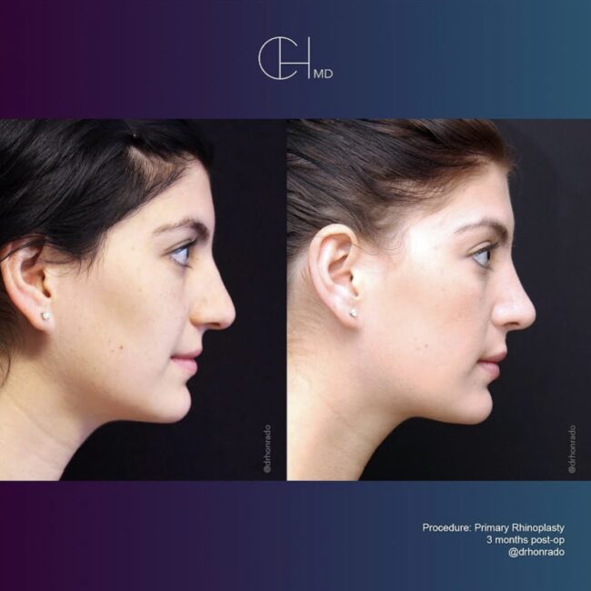 Primary Rhinoplasty Before and After by Dr. Honrado