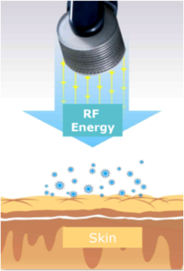 Image of Alma VShape RF Energy